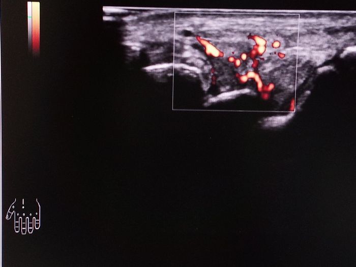 関節リウマチの手関節超音波エコー像